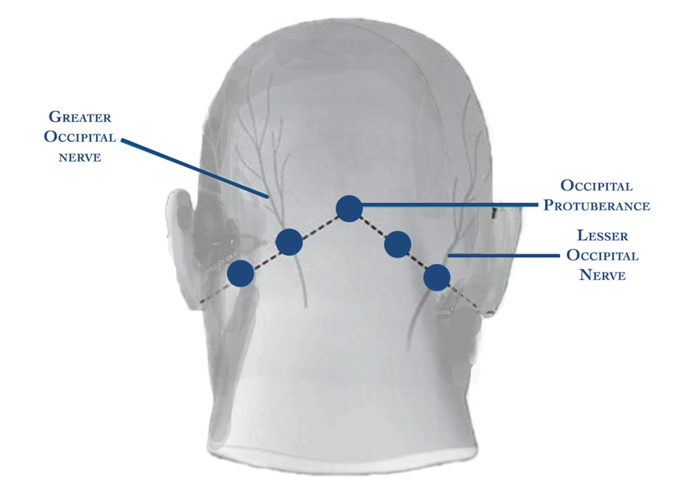 A New Device Can Help Healthcare Providers Treat Migraine Attacks