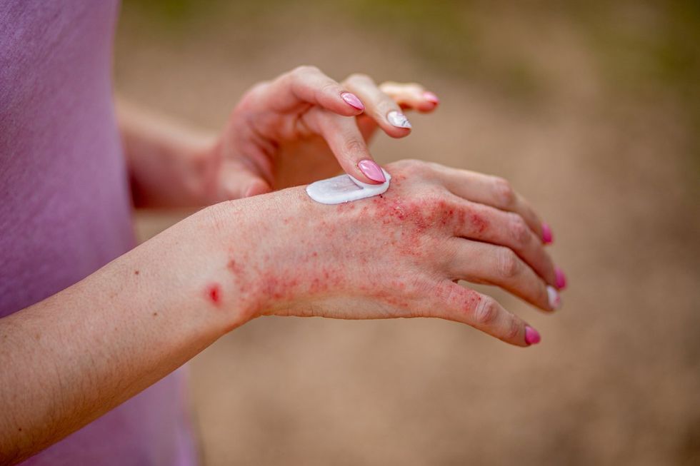 How Psoriasis Affects Your Overall Well-Being