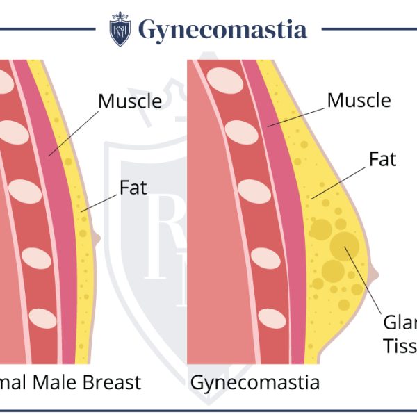 How To Dress When You Have Man Boobs?