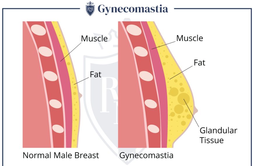 How To Dress When You Have Man Boobs?