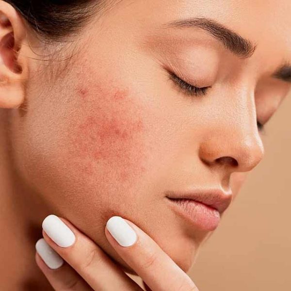 Poor Diet: A Contributing Factor in Acne